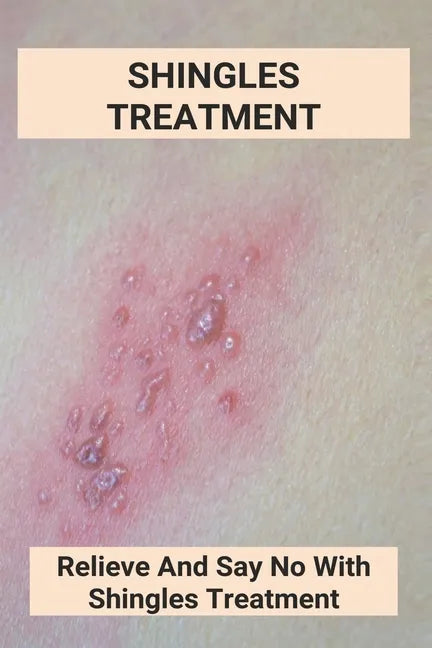 Shingles Treatment: Relieve And Say No With Shingles Treatment: Shingles On Face Treatment - Paperback