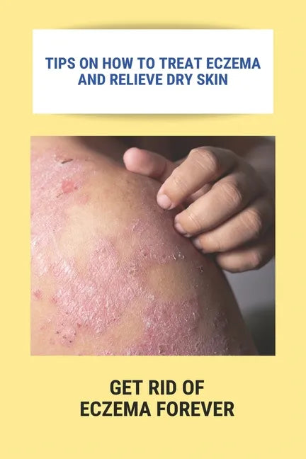 Tips On How To Treat Eczema And Relieve Dry Skin: Get Rid Of Eczema Forever: Overcome Eczema - Paperback
